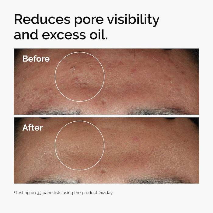 The Ordinary
Niacinamide 10% + Zinc 1% Oil Control Serum Size: 1 oz / 30 ml